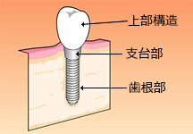 インプラント画像