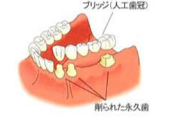 ブリッジ画像