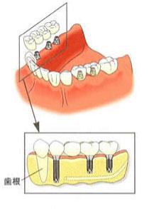 インプラント画像