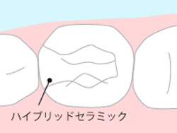ハイブリッドセラミックインレー